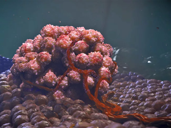 Illustration of tumor