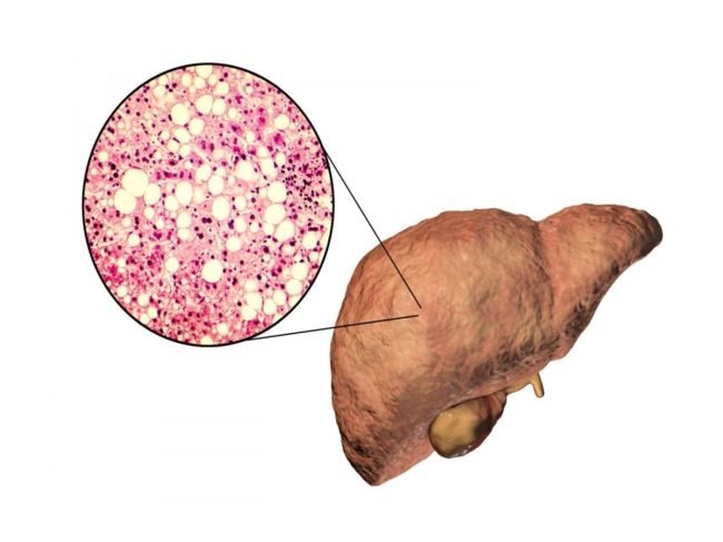 Triglyceride fat accumulated inside liver cells