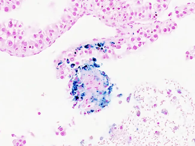 Cancer cells commandeer macrophages, depriving red blood cells of iron and supporting tumor growth