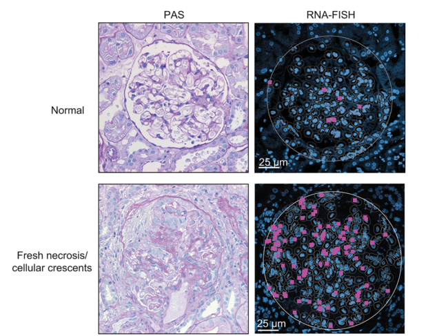 Representative images of MMP-12 stained (magenta) human kidney biopsies. 