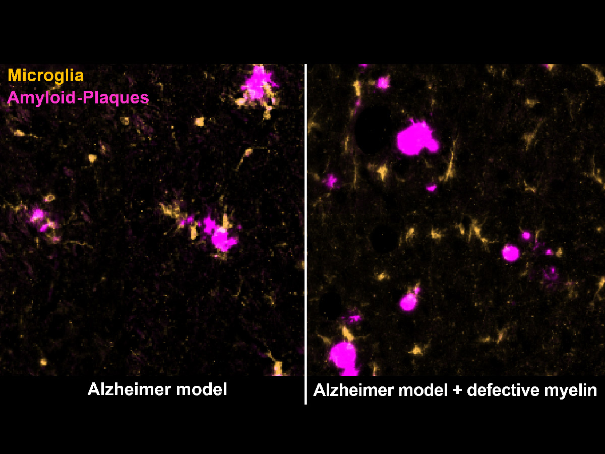 Myelin damage distracts microglia from amyloid plaques