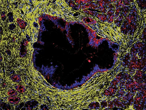 Immunofluorescence image of human donor pancreas with a precursor lesion lined by epithelial cells surrounded by fibroblasts. 