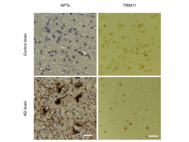 Figure comparing amount of neurofibrillary tangles  of tau proteins and TRIM11 in individuals with Alzheimer's vs. without