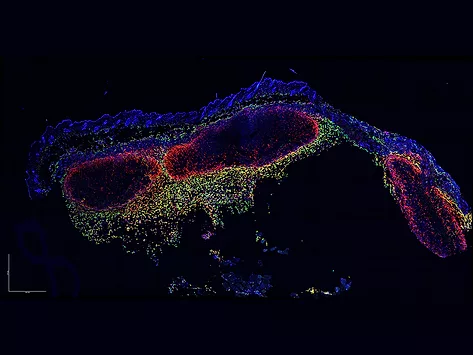 Microscopy of a cross-section of mouse skin containing melanoma tumors