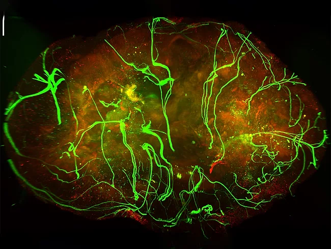 Nerves within a melanoma tumor