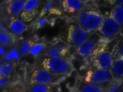 Stained image of triple-negative breast cancer showing molecular heterogeneity