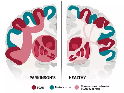 Illustration of SCAN in Parkinson’s vs healthy subcortex