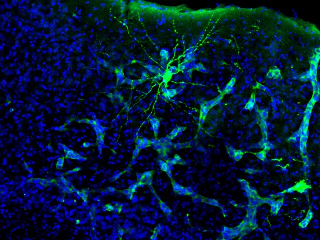 Metastasis in mouse brain. 