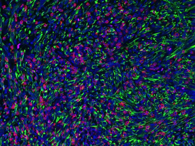 Tumor with FMRP-deficient cancer cells.