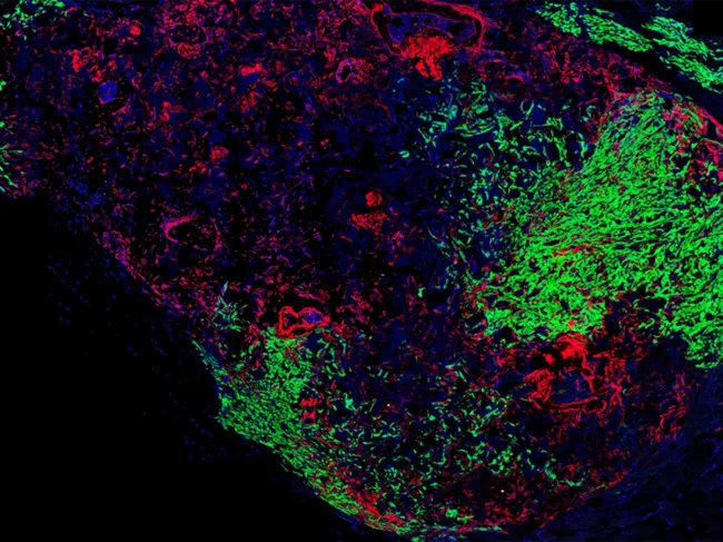 Stem cell-derived vertebral bone with recruited breast cancer tumor cells