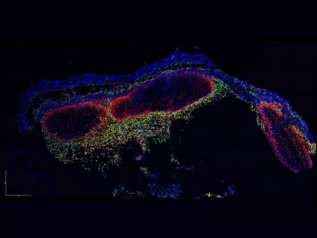 Microscopy of a cross-section of mouse skin containing melanoma tumors