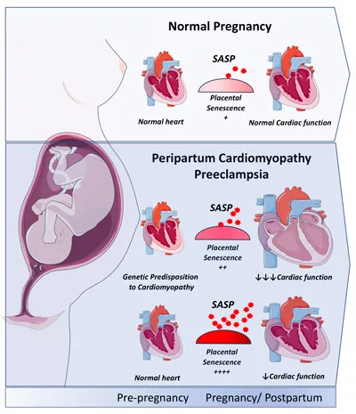 Figure comparing normal pregnancy to peripartum cardiomyopathy preeclampsia