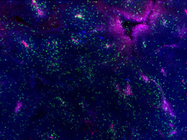 A mouse melanoma tumor showing MHC proteins and an infiltration of specialized immune cells