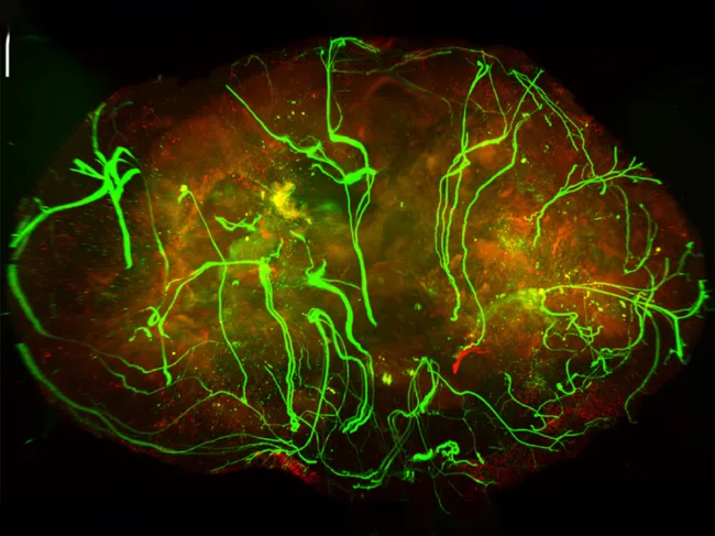 Nerves within a melanoma tumor