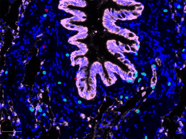 Tissue-resident memory T cells in the lung of smoker patients