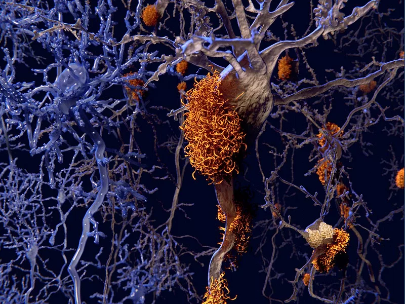 Tau neuron illustration Tau neuron illustration