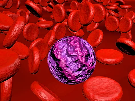 Acute myeloid leukemia illustration