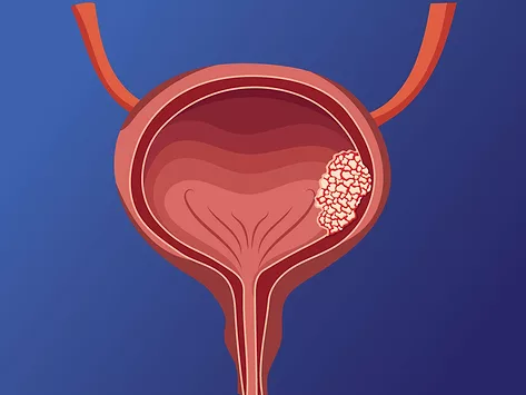 Bladder cancer illustration