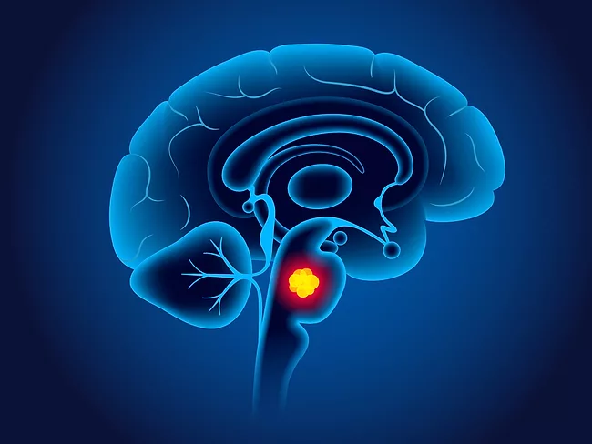 Illustration of glioma in the brain stem