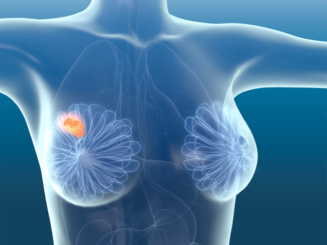 Illustration of tumor in breast