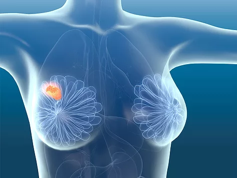 Breast cancer tumor
