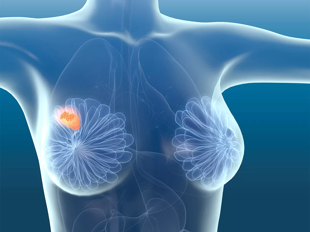 Astex Pharmaceuticals and Genentech collaborate in breast cancer