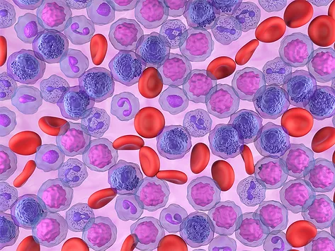 Illustration of acute myeloid leukemia (AML) cells in the blood stream