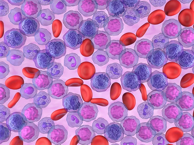 Illustration of acute myeloid leukemia (AML) cells in the blood stream