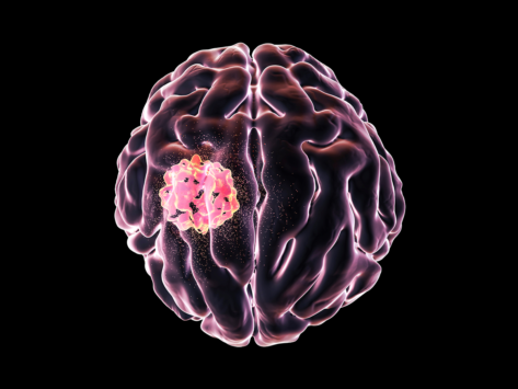 Cancer brain tumor treatment gbm