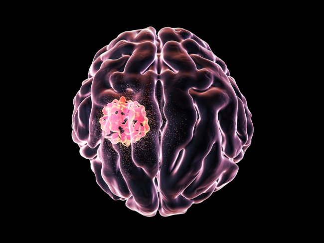 Conceptual image for brain cancer treatment