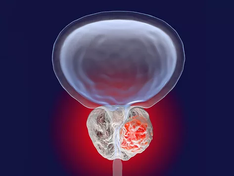 3D illustration showing presence of tumor inside prostate gland 