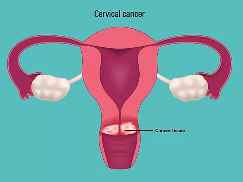 Cervical cancer cervix