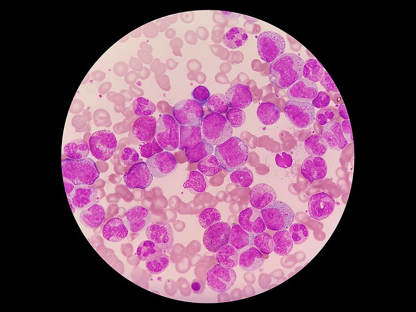 Enliven’s phase I CML data Enable phase III with BCR/ABL1 bid
