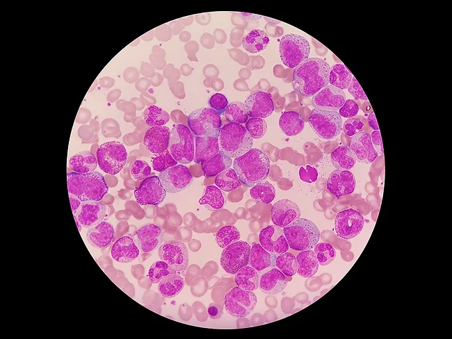 Microscopic image of chronic myeloid leukemia 