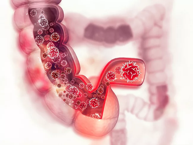 Colon cancer illustration
