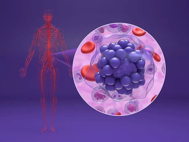 Diffuse large B-cell lymphoma - isometric view