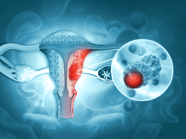 Endometrial/uterine cancer illustration