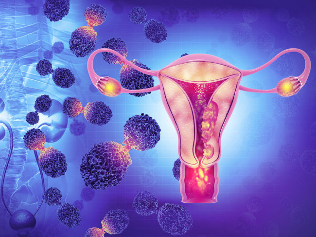 Female reproductive system and cancer cells