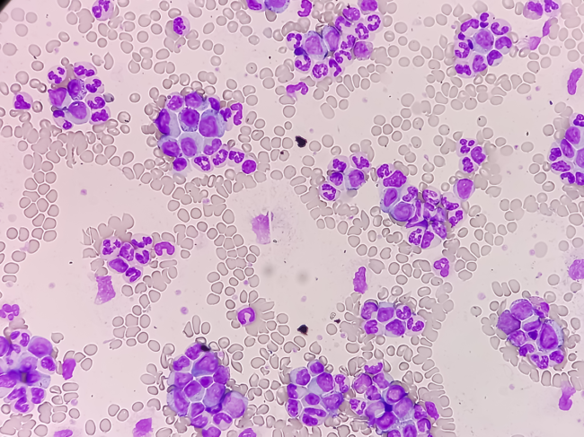 Microscopic image of blood cells, chronic myeloid leukemia and thrombocytosis