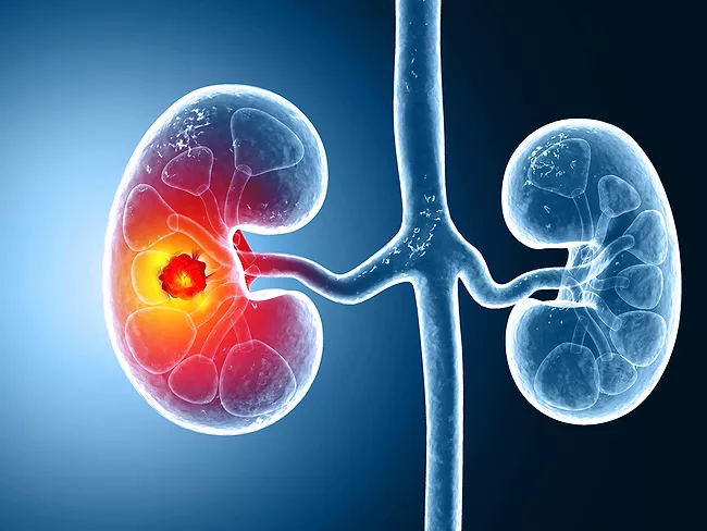Illustration of kidney cancer showing tumor inside the kidney