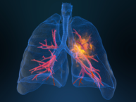 Lung cancer illustration