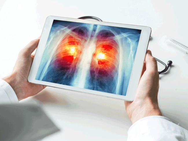 Xray showing lung cancer on tablet