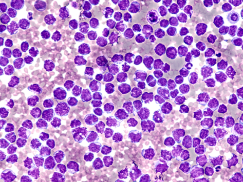 Mantle cell lymphoma 