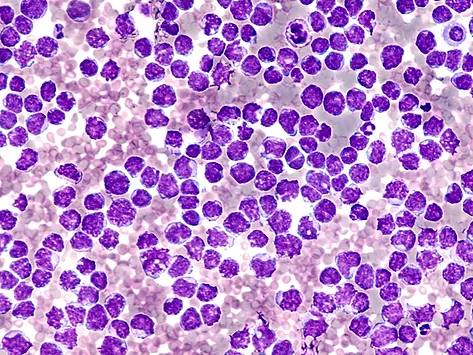Mantle cell lymphoma