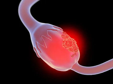Illustration of cancer on ovary