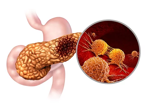 Pancreatic cancer anatomy