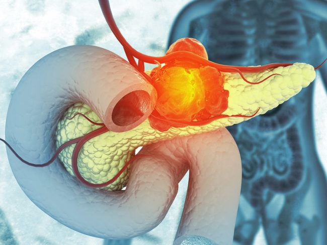 Illustration of cancer tumor on pancreas