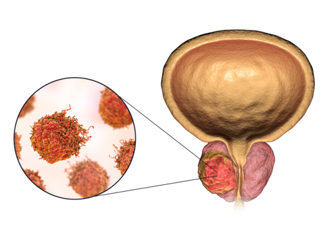 3D illustration showing tumor inside prostate gland and closeup view of cancer cells