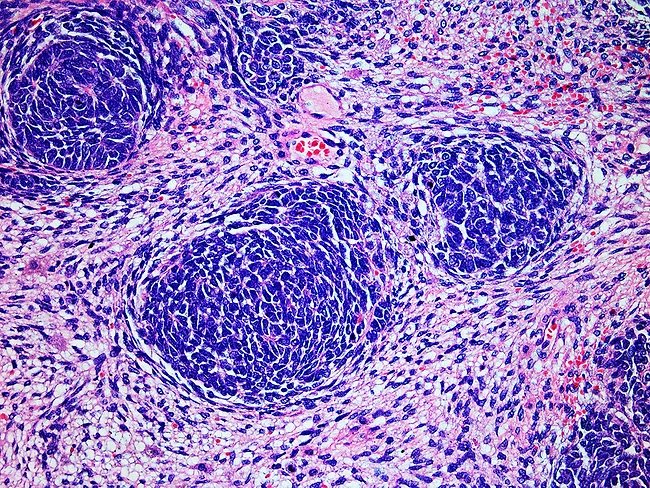 Microscopic image of a Wilms tumor of a pediatric kidney