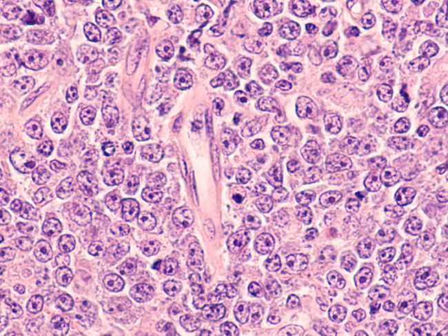 Photomicrograph of diffuse large B-cell lymphoma